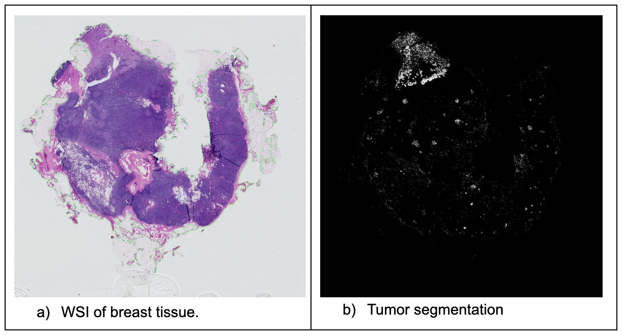 Tumor segmentation results